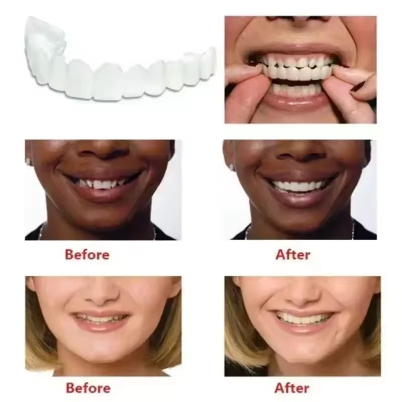 Veneers Dentários para Claream - Teeth Whitening Session avaliação e preço