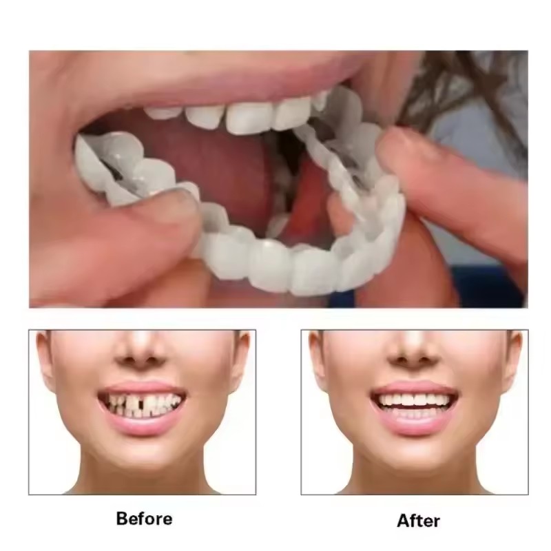 Veneers Dentários para Claream - Teeth Whitening Session avaliação e preço