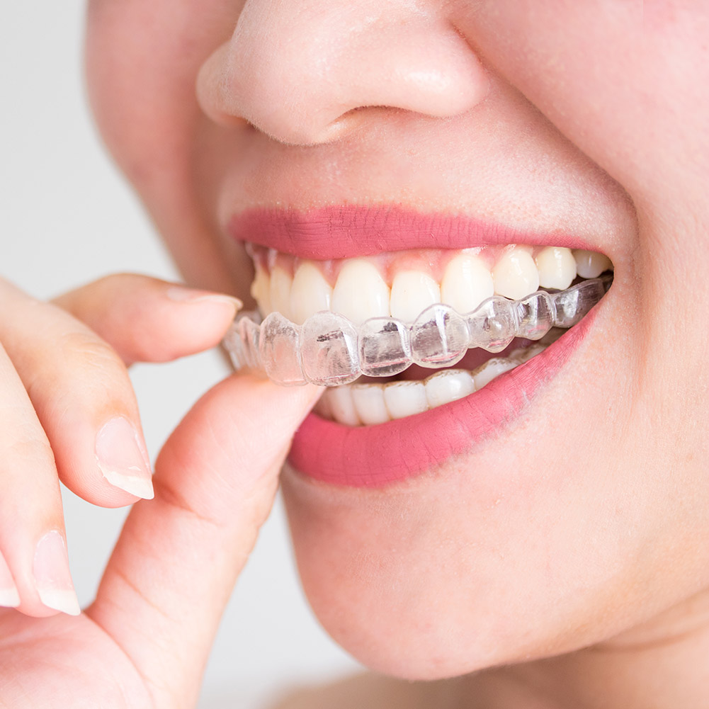 Conjunto de 2/4 Peças de Apare - Teeth Whitening Mouth Guard avaliação e preço