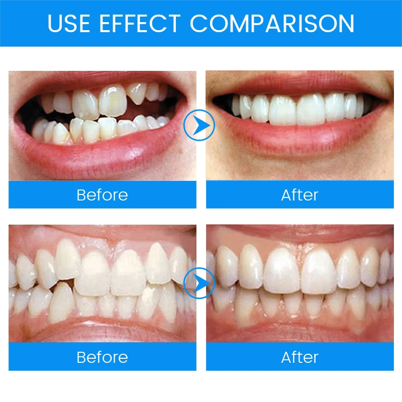 3 estágios dental ortodôntico  - Teeth Whitening Mouth Guard avaliação e preço
